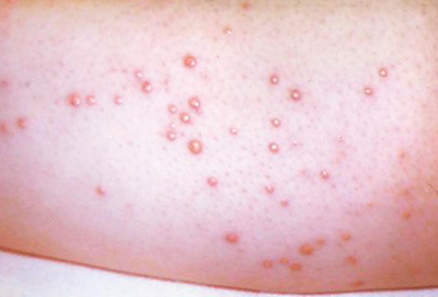 皮肤发现红黄色小丘疹可别轻忽,有可能就是高血脂与高血糖的警讯!